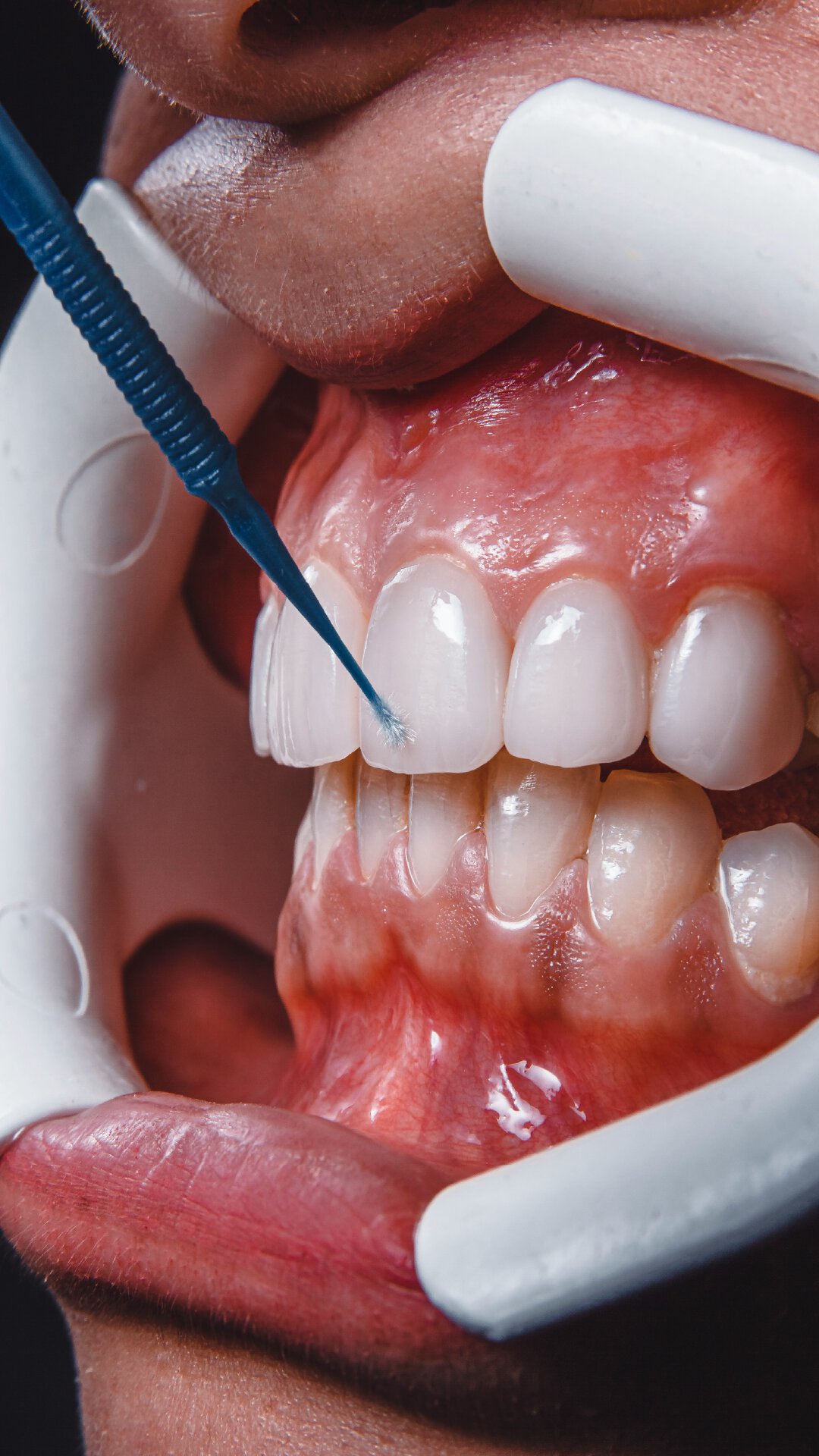 Hydroxylapatit: knstlicher Zahnschmelz schtzt die Zhne