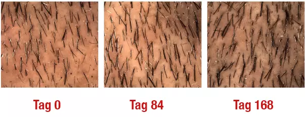 Drei Nahaufnahmen von Haut zeigen das Haarwachstum in Intervallen: "Tag 0," "Tag 84," und "Tag 168." Jedes Bild zeigt unterschiedliche Haardichte auf einer ähnlichen Hautoberfläche.