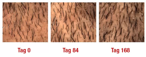 Drei Nahaufnahmen von Haut zeigen das Haarwachstum in Intervallen: "Tag 0," "Tag 84," und "Tag 168." Jedes Bild zeigt unterschiedliche Haardichte auf einer ähnlichen Hautoberfläche.