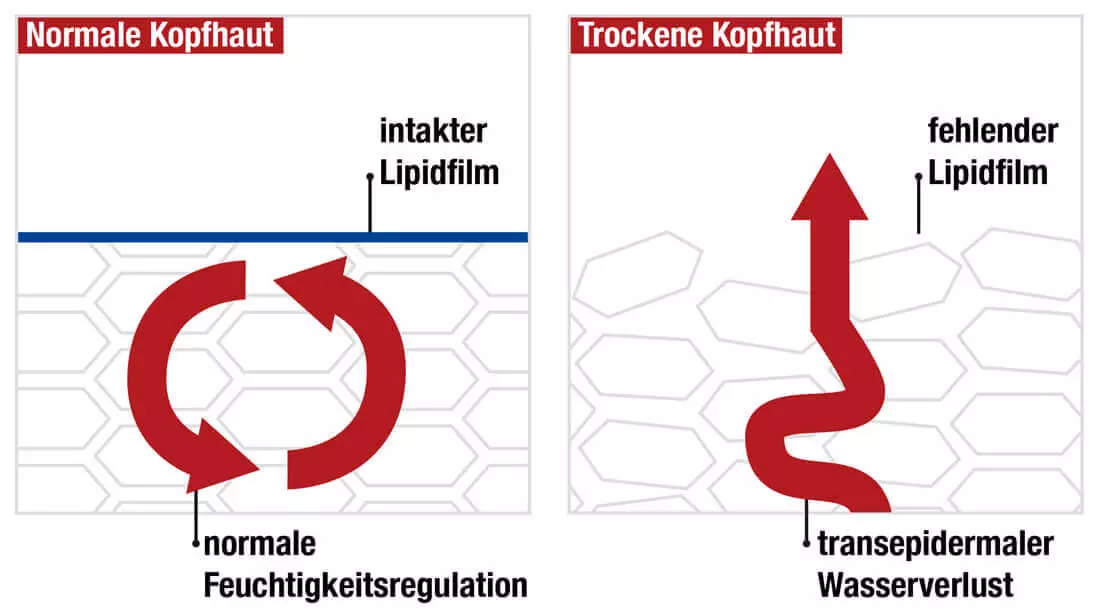 Schematische Gegenüberstellung von normaler Kopfhaut ohne Feuchtigkeitsverlust und trockener Kopfhaut aufgrund von einer gestörten Hausbarriere und fehlendem Lipidfilm