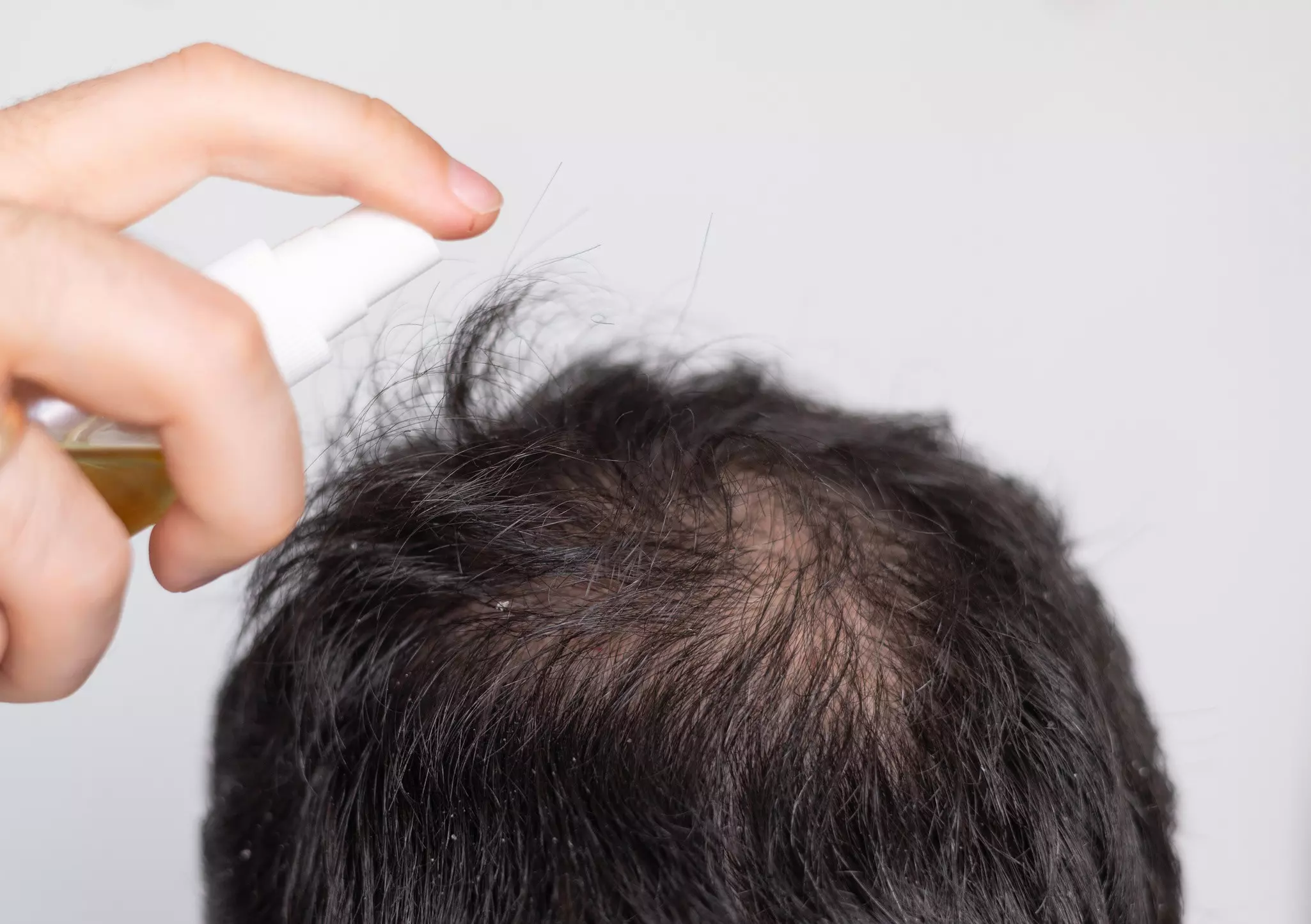 Mann sprüht sich ein Hausmittel gegen Haarausfall auf den Hinterkopf, der sichtbare von erblich bedingtem Haarausfall betroffen ist