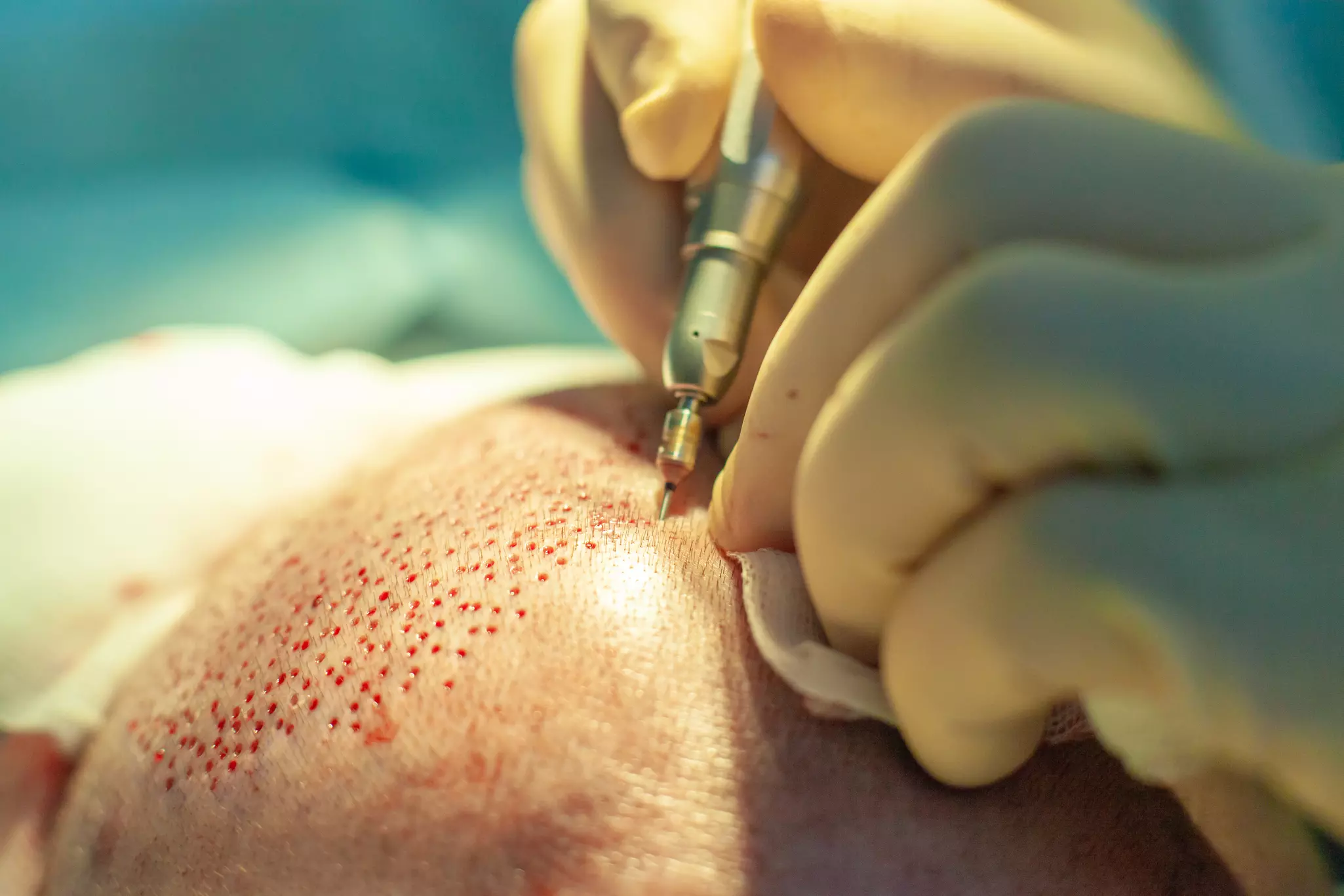 Nahaufnahme des Hinterkopfes eines Mannes beim Einsetzen der Grafts während einer Haartransplantation