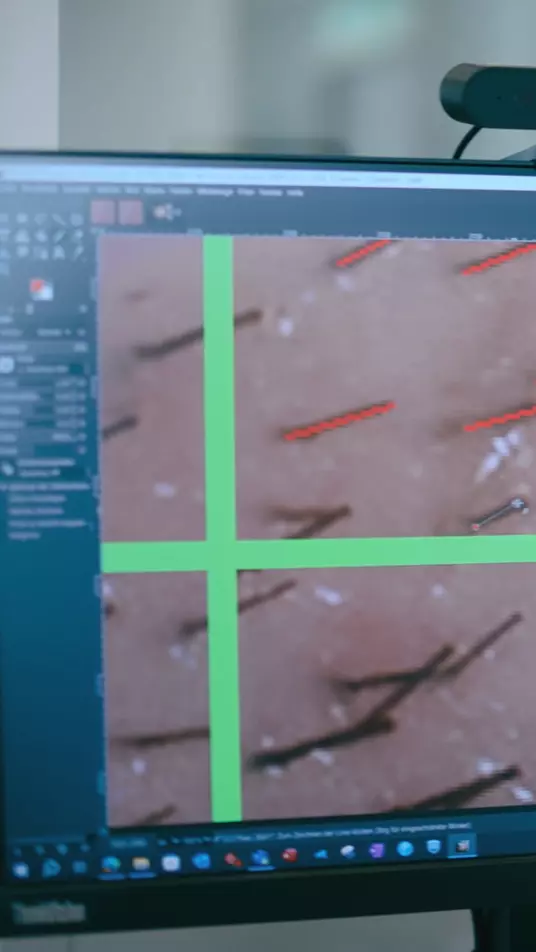 Fokus auf einen Bildschirm, auf dem eine Nahaufnahme von Kopfhaaren zu sehen ist, zur Verdeutlichung, dass Dr. Wolff zusammen mit dem Fraunhofer Institut eine neue Methode entwickelt hat, um erblich bedingten Haarausfall bei Männern zu analysieren